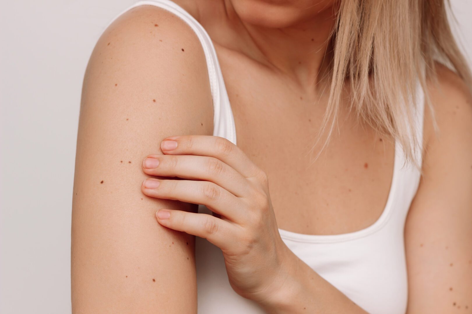Cropped shot of a young blonde woman with a large number of moles on her arms isolated on a white background. The effect of sunlight on the skin