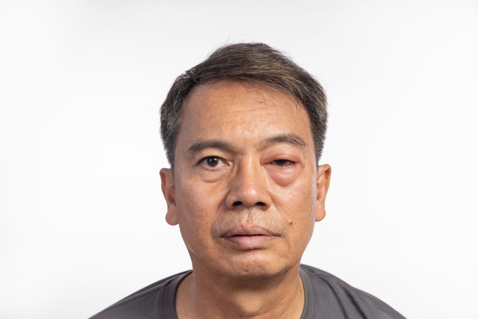 Senior man with swollen eye from insect bite on white background.
