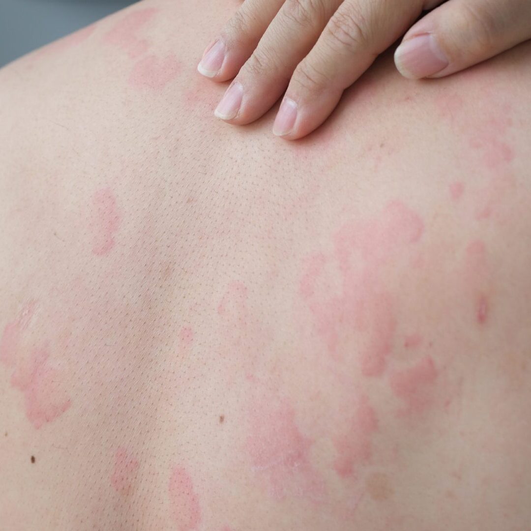 Close up image of skin texture suffering severe urticaria or hives or kaligata on back. Allergy symptoms.