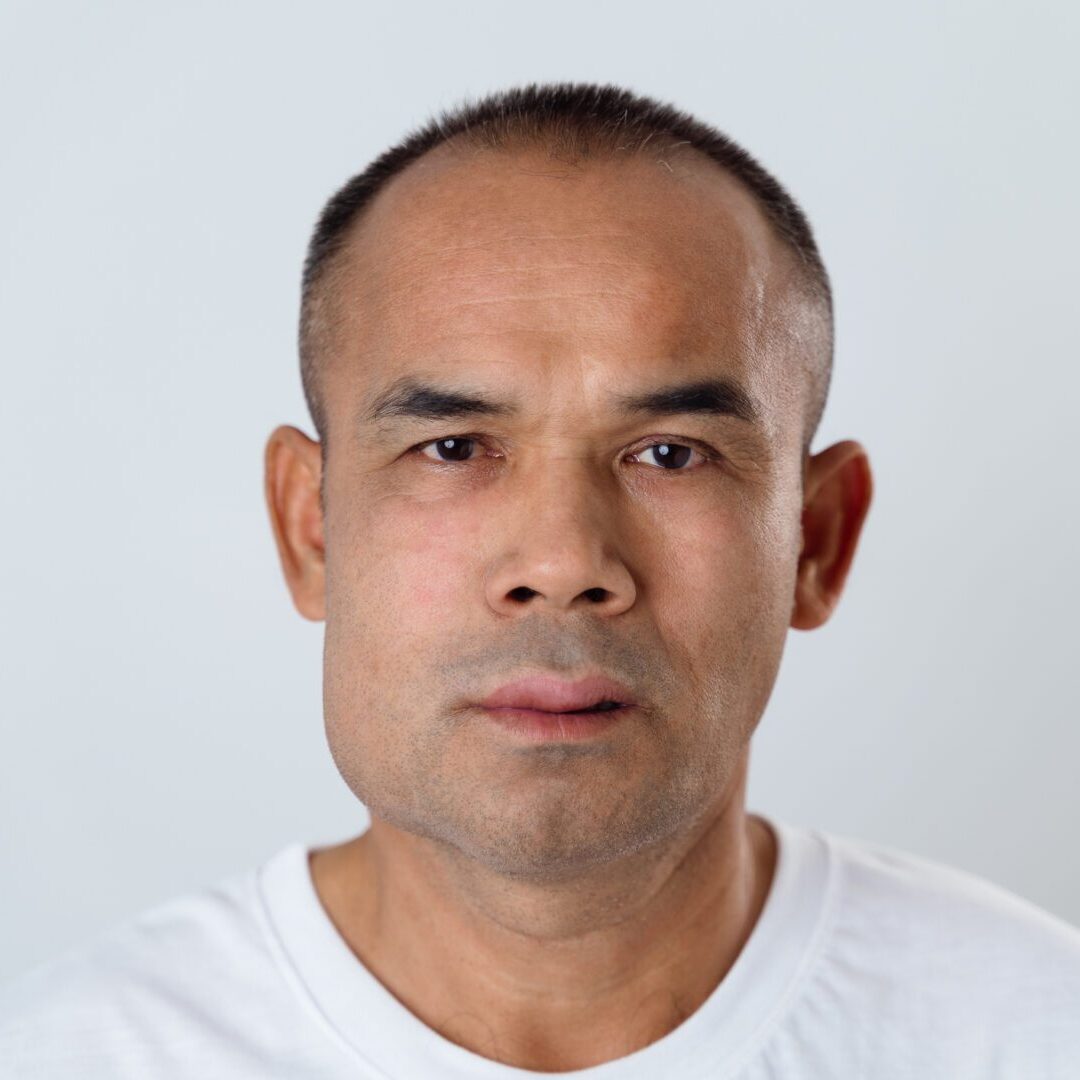 The man has facial swelling due to an allergic reaction to triggers such as insect bites stings, food, or medication. Close up of a swollen face.