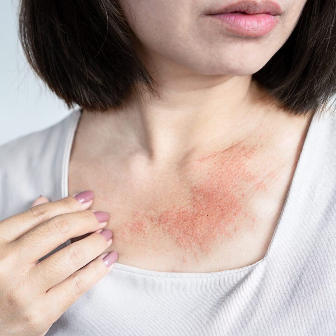 Close-up of a woman with red, itchy skin on her neck from a rash, caused by dryness, allergies, eczema, or sweating in hot weather